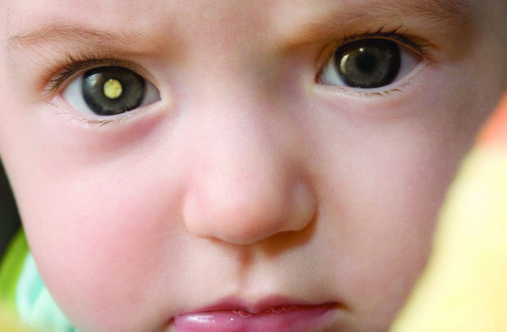 تشخیص سرطان شبکیه در کودکان زیر 5 سال با استفاده از فلاش دوربین